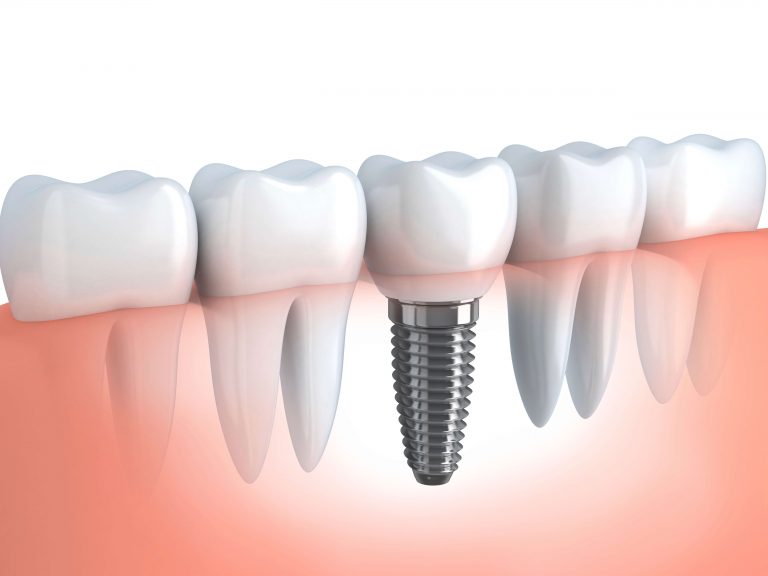 Implant dentaire : est-il indispensable de recourir à la greffe osseuse ?